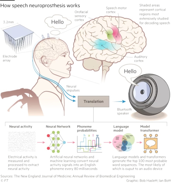 &laquo;Голосовое протезирование с ИИ&raquo; превратит мозговые волны немых людей в беглую речь